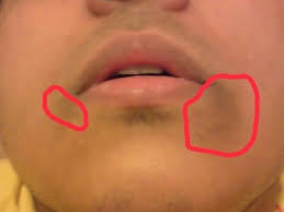 How To Get Rid Of Dark Skin Around Mouth Remove Hyperpigmentation Dark Upper Lip Dark Dark Skin Around Mouth Removing Hyperpigmentation Dark Spots On Face