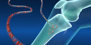 Image result for Intraosseous Access