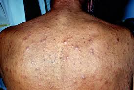 Syphilis is a sexually transmitted infection caused by the bacterium treponema pallidum subspecies pallidum. Stages Of Syphilis And All You Need To Know About It Syphilis