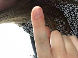 Hallo dr.busse, unsere tochter 4 1/2 jahre hat sich heute an der autotür den zeigefinger gequetscht. Finger Gequetscht Soll Ich Zum Arzt Quetschung