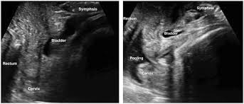 Image result for Vaginal Pooling