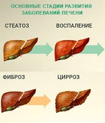 Vidy Zabolevanij Pecheni Prichiny Priznaki Simptomy I Profilaktika Boleznej Pecheni