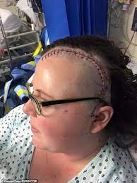 Some malignant tumors have edges that are hard ot define, which makes it difficult for surgeons to side effects of chemotherapy may include hair loss, nausea, digestive problems, reduced bone marrow production, and fatigue. Woman Reveals She Discovered She Had A Brain Tumour After Smelling Burnt Toast Daily Mail Online