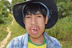 JOSÉ DAVID BALVIN MELO ES UN NIÑO DE BAJOS RECURSOS ECONÓMICOS QUE RADICA  EN LA CC NN DE MARISCAL CÁCERES DE PERENE SUFRE DE UNA ENFERMEDAD QUE SE LE  ESTÁ CRECIENDO LAS