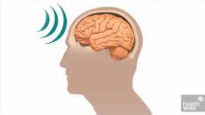 Image result for Concussion