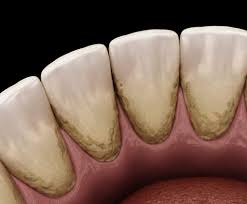Tartar on teeth can also be formed at and beneath the gum line and can irritate the gum tissues.tartar offers plaque more area on which to develop and a stickier surface area to develop which can cause more serious dental conditions such as gum disease and cavities. Kitchener Dentist Files Why Do I Get So Much Tartar On My Bottom Teeth Enamel Republic