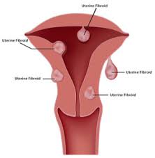 Uterine fibroids are benign (not cancer) growths that develop from the muscle tissue of the uterus. What Are The Signs And Symptoms Of Uterine Fibroids