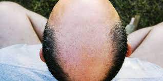 9 effective ways to stop hair loss in men. 7 Ways To Stop Hair Loss Treatments And Prevention