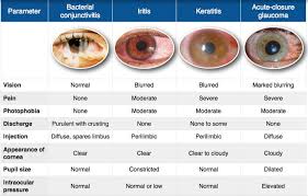 Image result for Acute Red Eye