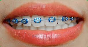 Pin On Braces