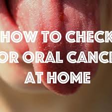 Questions about bumps in mouths are very common ones so he and his team put together a list of the 12 most common causes, symptoms and a guideline to while many bumps on the roof of the mouth will resolve without treatment, some may require medical intervention. How To Check For Mouth Cancer At Home Healthproadvice
