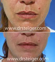 After the treatment your face will be red straight away. Fractional Co2 Laser Before And After Photos