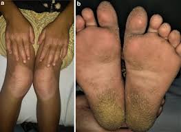 Disorders of Keratinization