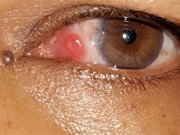 We did not find results for: Pyogenic Granuloma Eye Health Eye Surgery Eyes