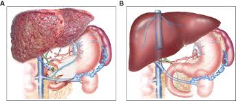 Nessly ft lil yachty season. Novel Classification Of Non Malignant Portal Vein Thrombosis A Guide To Surgical Decision Making During Liver Transplantation Journal Of Hepatology