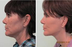 › best jowl and neck procedures. Best Jowl Treatment Facelift Necklift Las Vegas The Lanfranchi Center