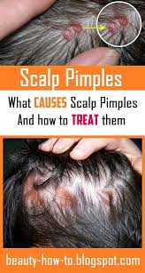 Scalp Pimples What Causes Them And How To Treat Them Pimples On Scalp Scalp Acne Sores On Scalp