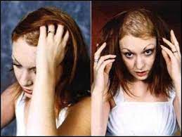Pin On Baldness And Hair Loss