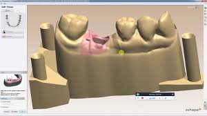 Digital Implant Model Design In 3shape