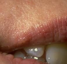 The mild herpes photo gallery below shows what mild symptoms look like of the herpes simplex virus type 1 and 2. Mild Herpes Photos The Hsv Blog