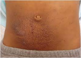 Nickel Dermatitis Visual Diagnosis