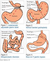 bariatric surgery for the treatment of