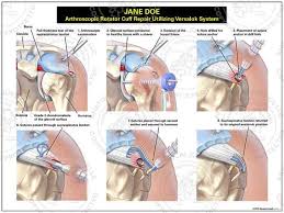 Arthroscopic Rotator Cuff Repair Utilizing Versalok System Rotator Cuff Supraspinatus Tendon Tear Medical Illustration