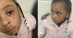 Kindergartner hit in the face with ruler by teacher for telling