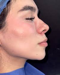 EL PERFILAMIENTO FACIAL. Te presento una secuencia del tratamiento en 6  meses de evolución, el fin de semana le realizamos una RINOMODELACIÓN y  DISEÑO DE LABIOS con ácido hialurónico, como parte del