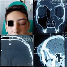 Clinical aspect and CT findings in Case 3.