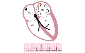 Image result for Extrasystole