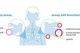 Causes Of Bronchiectasis British Lung Foundation