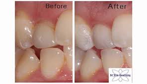 We did not find results for: How Much Do Teeth Veneers Cost