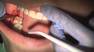 You may also notice swollen gums. Impacted Wisdom Teeth Argentina Pdf Ppt Case Reports Symptoms Treatment