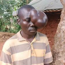 At Kitale county, we meet Kevin Sang, a 36-year-old young man who is  suffering from a growth on his face. When the growth started, he complained  of having an eye problem. The