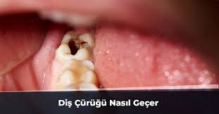Benim dişlerimde her iki hamileligimde olusan siyah lekelenmeler var bunları doğal şekilde nasıl gecirebilirim. Dis Curugu Nasil Gecer Dis Curugu Kokusu Nasil Gecer