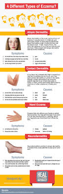 This Infographic Was Created By Heal Eczema Naturally The Most Common Type Of Eczema Is Ato Natural Eczema Treatment Home Remedies For Eczema Eczema Treatment