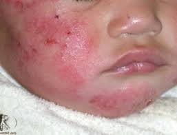 Herpesul zoster este o infectie virala care se manifestă cel mai adesea pe vreme rece și lovește pacienții vârstnici și cei debili. Zona Zoster Sos Dermatolog