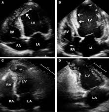 Chagas Cardiomyopathy: An Update of Current Clinical Knowledge and  Management: A Scientific Statement From the American Heart Association |  Circulation