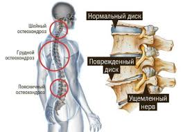 можно ли заниматься в тренажерном зале при шейном остеохондрозе Sport Pri Osteohondroze Kakie Trenirovki Vybrat Protivopokazaniya