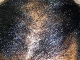 Cheek rashes can be caused by a wide variety of mild to serious diseases, disorders and conditions. Will I Catch That Scalp Rash Western Focus Jamaica Gleaner