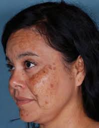 Treating Epidermal Melasma With a 4% Hydroquinone Skin Care System Plus  Tretinoin Cream 0.025%