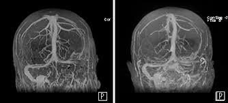 Handbook of clinical neurology, 2014. Postoperative Cerebral Venous Sinus Thrombosis In The Setting Of Surgery Adjacent To The Major Dural Venous Sinuses In Journal Of Neurosurgery Volume 131 Issue 4 2018