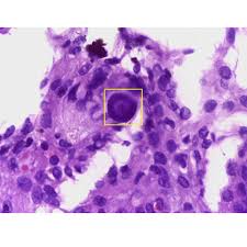 The histology of mesothelioma can provide insight to those who have been or have loved ones diagnosed with this cancer. Remember Last Tuesday S Step 1 First Aid Usmle Rx Facebook