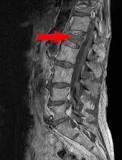 Image result for icd 10 code for thoracic compression deformity