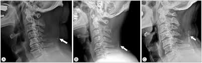 Continuous with the supraspinous ligament. The Clinical Significance Of Ossification Of Ligamentum Nuchae In Simple Lateral Radiograph A Correlation With Cervical Ossification Of Posterior Longitudinal Ligament Abstract Europe Pmc