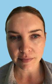 Katrina Has A Non-Surgical Facelift with PDO Threads