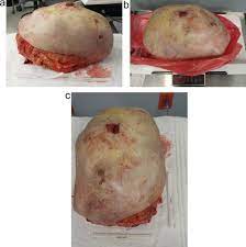 phyllodes tumors (pts) are well known for local recurrence and progression. Aggressive Malignant Phyllodes Tumor Sciencedirect