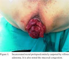 Carpet Villous Adenoma Of The Rectum In An Incarcerated Rectal Prolapse