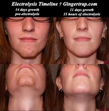 It is designed to eliminate any fair, blonde, grey or white hairs on your face and body with long lasting results! Electrolysis
